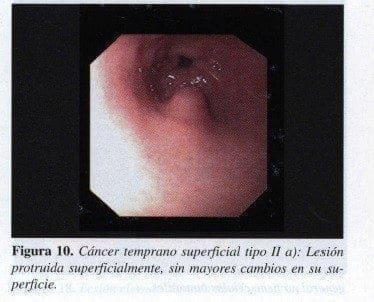 Cáncer temprano superficial tipo II