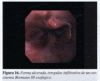 Forma ulcerada