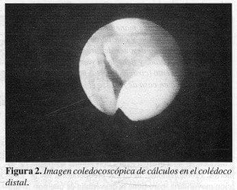 Imagen Coledocoscópica de Cálculos en el Colédoco Distal Imagen Coledocoscópica de Cálculos en el Colédoco Distal