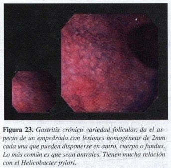 Gastritis Crónica variedad Folicular