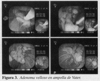 Adenoma velloso en ampolla de Vater