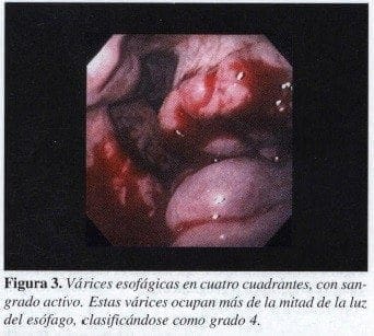 Várices Esofágicas en cuatro cuadrantes