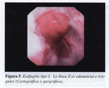 Esofagitis tipo I