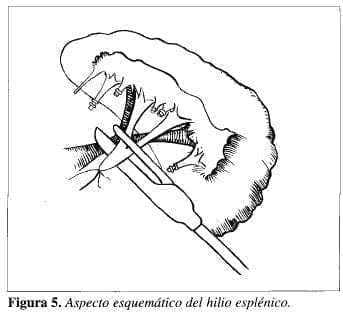 Aspecto esquemático del Hilio Esplénico