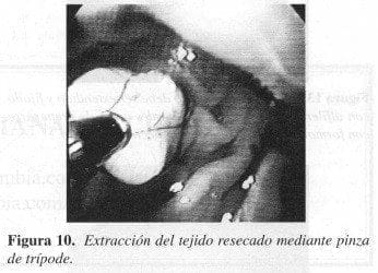 Extracción del tejido resecado mediante Pinza de Trípode