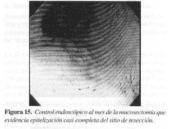 Control Endoscópico al mes de la Mucosectomía