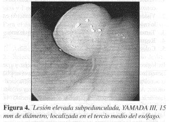 Lesión Elevada Subpedunculada