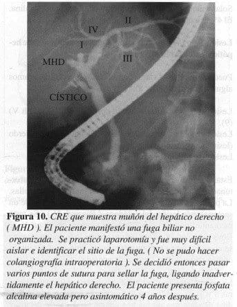 Muñón del Hepático Derecho