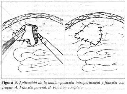 Hernia Incisional, Aplicación de la malla