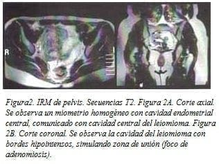 Miometrio Homogéneo con cavidad Endometrial central