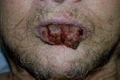 Carcinoma escamocelular agresivo