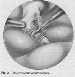Colecistectomía Laparoscópica