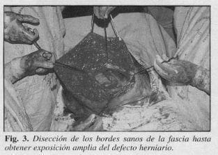 Exposición Amplia del Defecto Herniario Exposición Amplia del Defecto Herniario