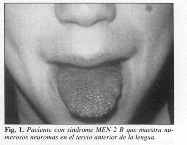 Paciente con síndrome MEN 2 B Paciente con síndrome MEN 2 B