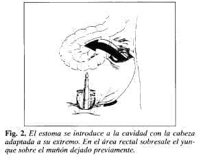 Cavidad con la Cabeza Adaptada a su Extremo Cavidad con la Cabeza Adaptada a su Extremo