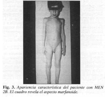 Aspecto Marfanoide Aspecto Marfanoide