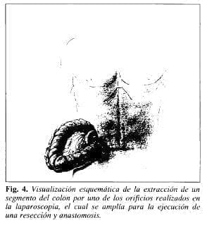 Extracción de un Segmento del Colon Extracción de un Segmento del Colon