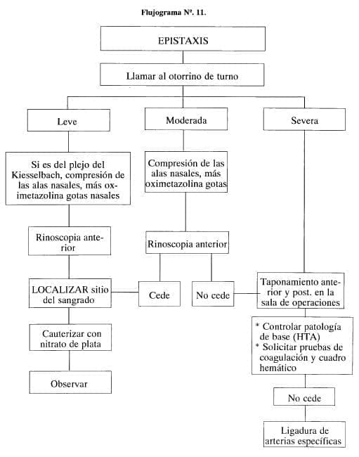 Epistaxis Epistaxis