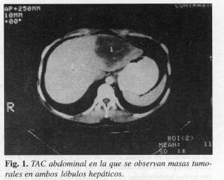 Masas Tumorales en ambos Lóbulos Hepáticos