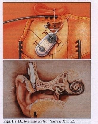 Implante Coclear Nucleus Mini 22