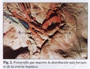 Distribución más frecuente de la Arteria Hepática