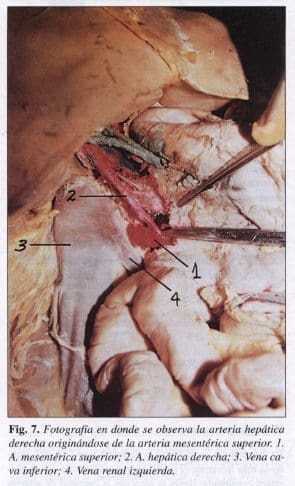 Arteria Hepática derecha originándose de la Arteria Mesentérica superior