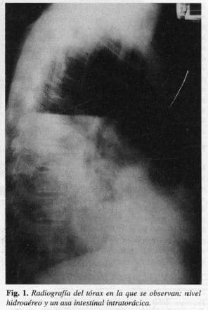 Hidroaéreo y un asa Intestinal Intratorácica