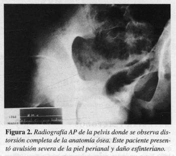 Pelvis donde se observa Distorsión completa de la Anatomía Ósea