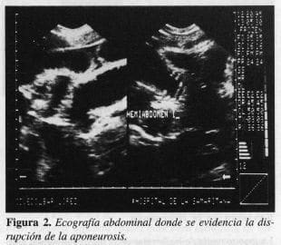 Ecografía Abdominal