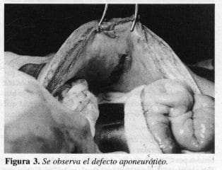 Defecto Aponeurótico