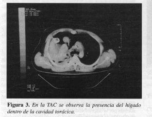 Hígado dentro de la Cavidad Torácica