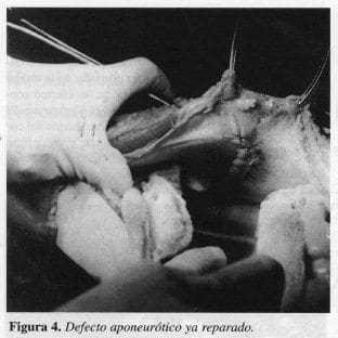 Defecto Aponeurótico ya Reparado