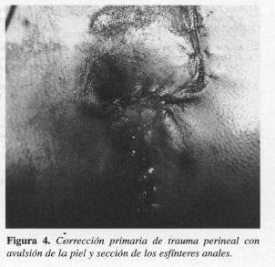 Trauma Perineal con Ovulsión de la Piel