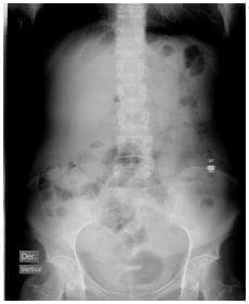Obstrucción intestinal