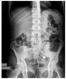 Distensión de asas intestinales