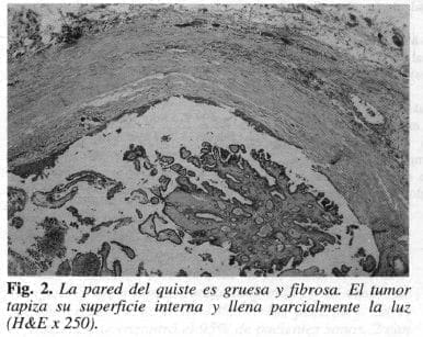 La Pared del Quiste es Gruesa y Fibrosa