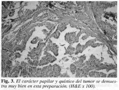 Carácter Papilar y Quístico del Tumor