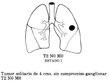 Compromiso Ganglionar