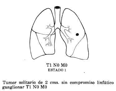 Compromiso Linfático Ganglionar