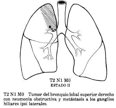 Neumonía Obstructiva y Metástasis