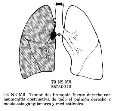 Tumor del Bronquio