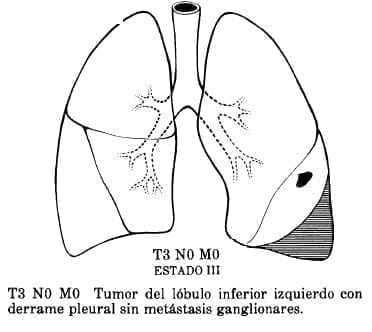 Tumor del Lóbulo
