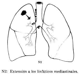 Extensión a los Linfáticos Mediastinales