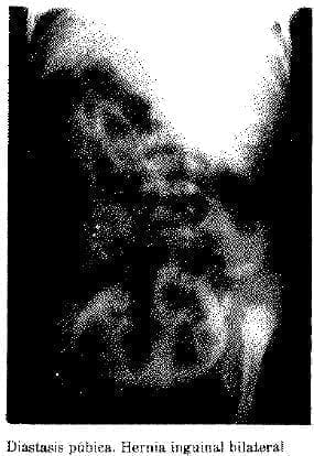 Diastasis púbica. Hernia Inguinal Bilateral