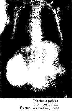 Hemivértebras. Exclusión renal izquierda Hemivértebras. Exclusión renal izquierda