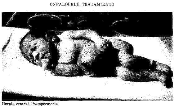 Hernia ventral Hernia ventral