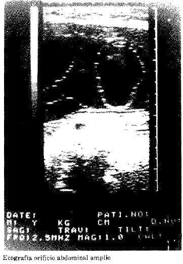 Ecografía orificio Abdominal Amplio Ecografía orificio Abdominal Amplio