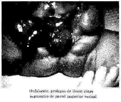 Prolapso de Ileum entre segmentos de pared posterior vesical Diastasis Prolapso de Ileum entre segmentos de pared posterior vesical Diastasis
