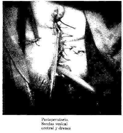 Sondas Vesical Uretral y Drenes