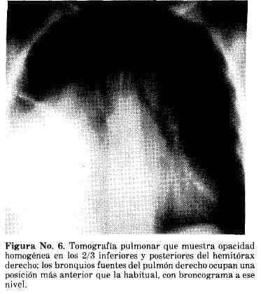 Tomografía Pulmonar que muestra Opacidad Homogénea